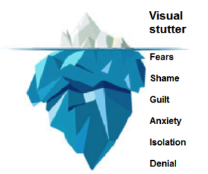 The Sheehan iceberg model for suttering